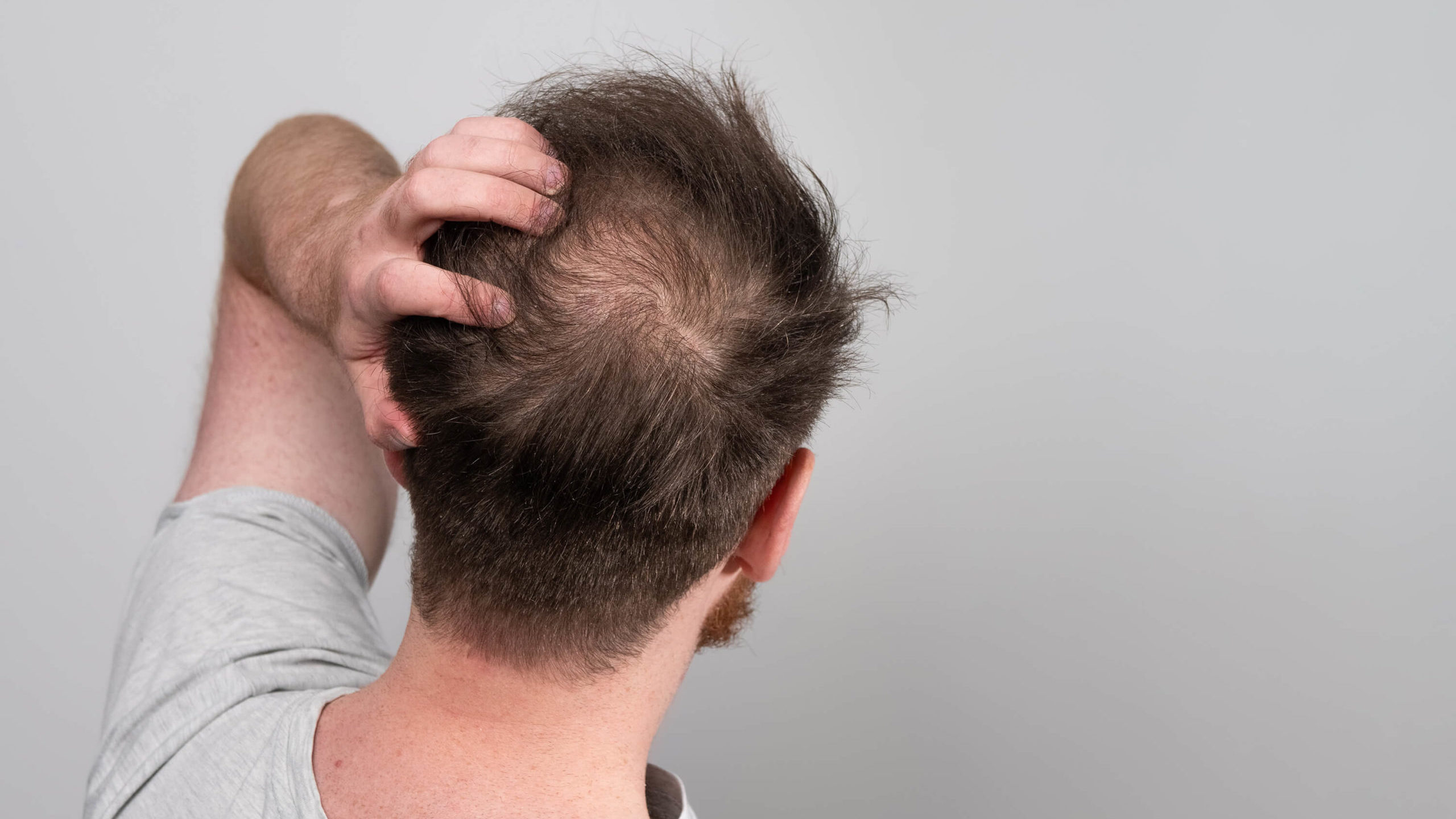 Haarwurzelentzündung: Schnelle Hilfe bei unangenehmen Beschwerden